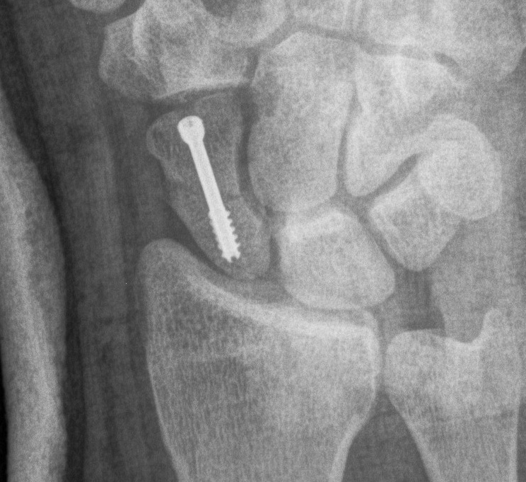 Scaphoid ORIF Volar Approach